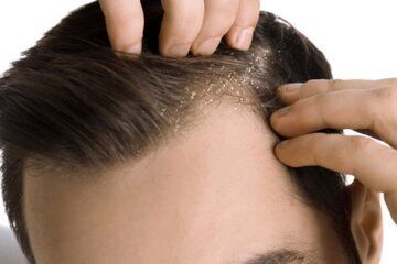 مهم‌ترین علت های شوره سر چیست؟