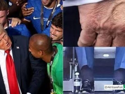 ارزیابی پزشک از وضعیت سلامتی دونالد ترامپ؛ تورم در پاها و کبودی روی دست